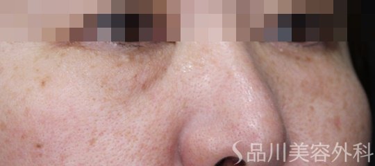 症例NO.66826のBEFORE写真