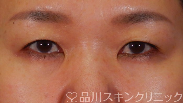 症例NO.67199のBEFORE写真