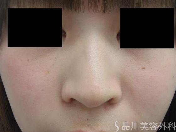 症例NO.4012のBEFORE写真