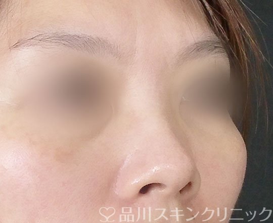 症例NO.62138のBEFORE写真