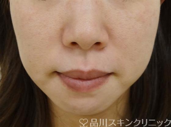 症例NO.40587のBEFORE写真