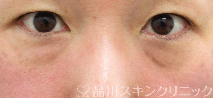 症例NO.63546のBEFORE写真