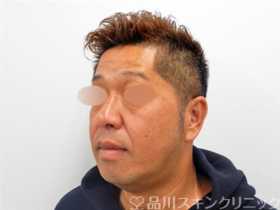 症例NO.53268のBEFORE写真