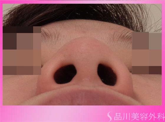 症例NO.32168のBEFORE写真