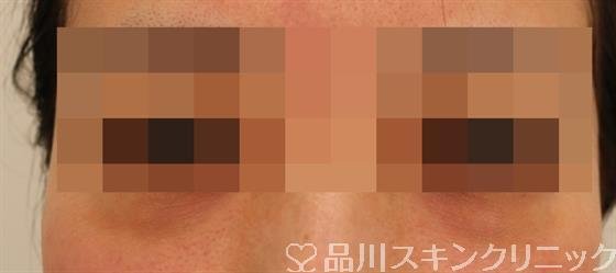 症例NO.50026のBEFORE写真