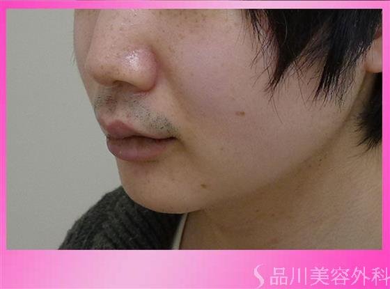 症例NO.41657のBEFORE写真