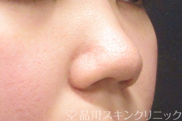 症例NO.62899のBEFORE写真