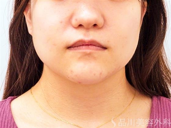 症例NO.51070のBEFORE写真