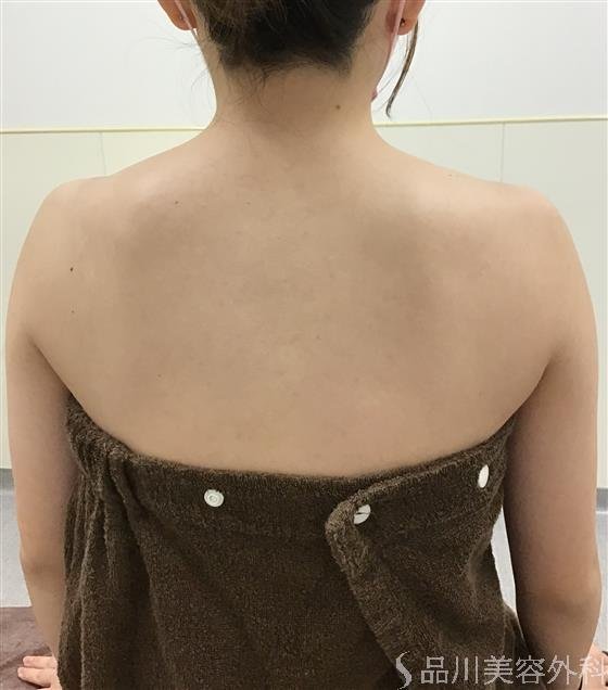 症例NO.53199のBEFORE写真