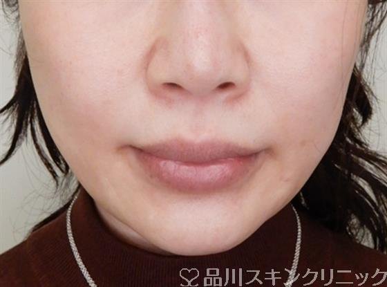 症例NO.50260のBEFORE写真