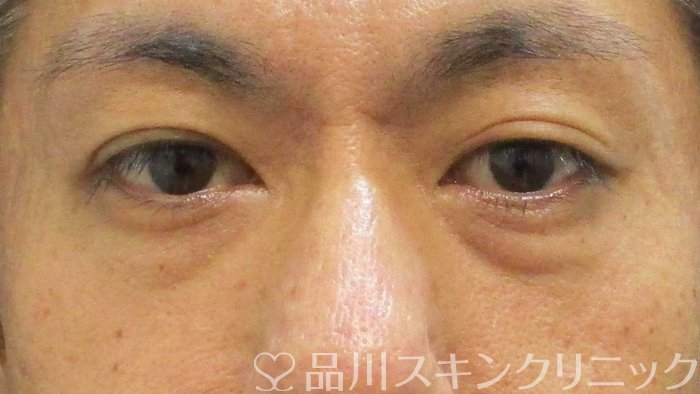 症例NO.66174のBEFORE写真