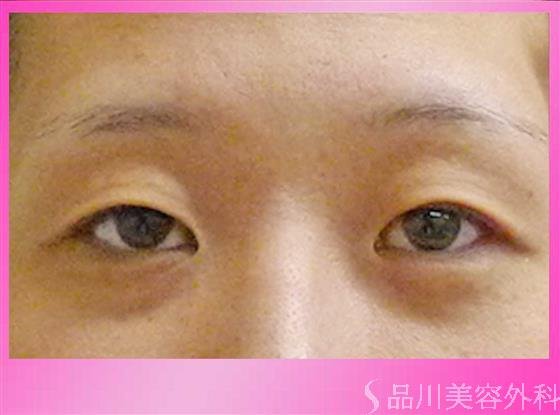 症例NO.36096のBEFORE写真