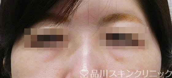 症例NO.51741のBEFORE写真