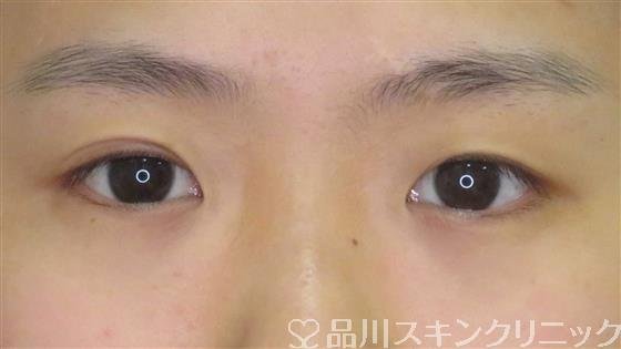 症例NO.61010のBEFORE写真