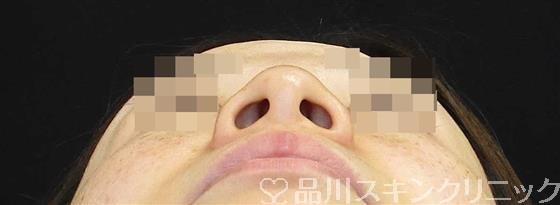 症例NO.60871のBEFORE写真