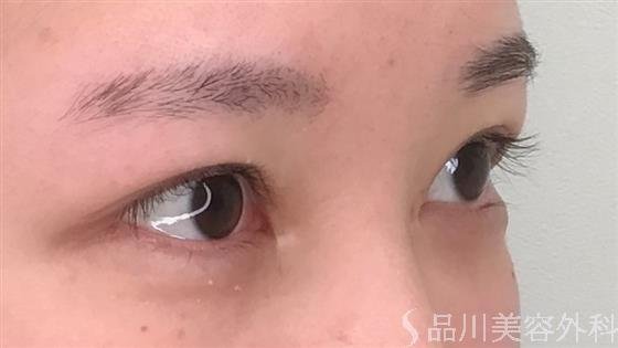 症例NO.54595のBEFORE写真