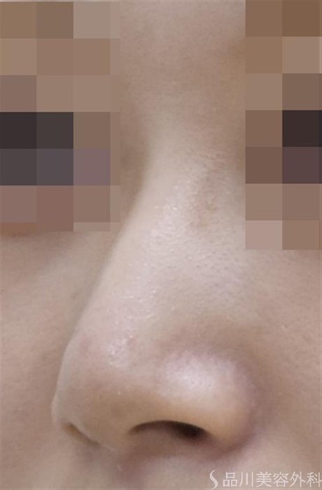 症例NO.57086のBEFORE写真