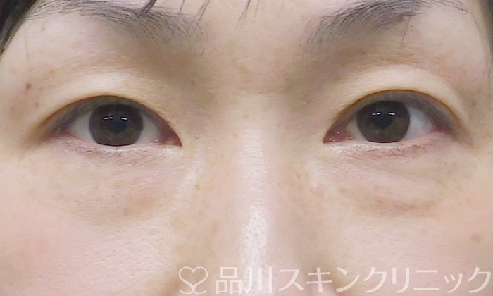 症例NO.66075のBEFORE写真