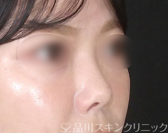 症例NO.67249のBEFORE写真