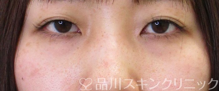 症例NO.66777のBEFORE写真