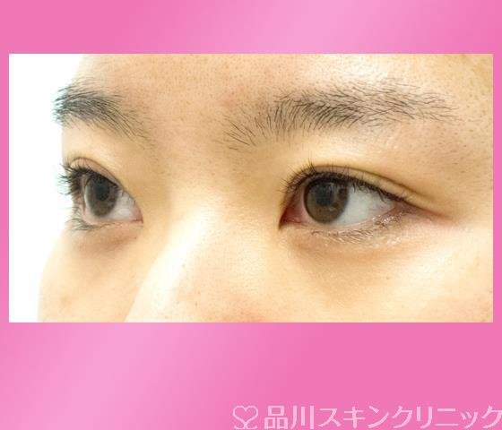 症例NO.27220のBEFORE写真