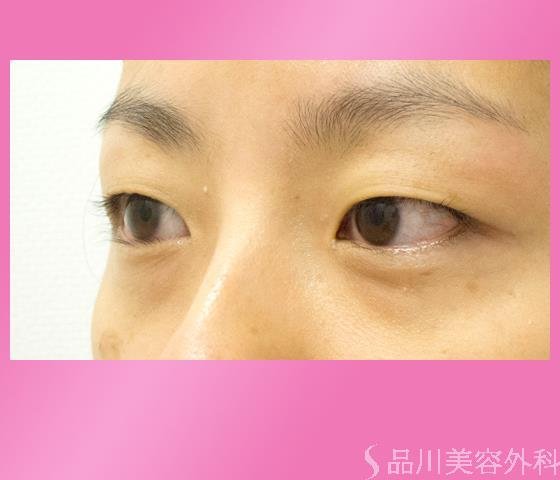 症例NO.25363のBEFORE写真