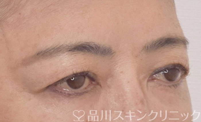 症例NO.62924のBEFORE写真