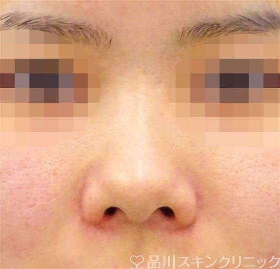 症例NO.45091のBEFORE写真