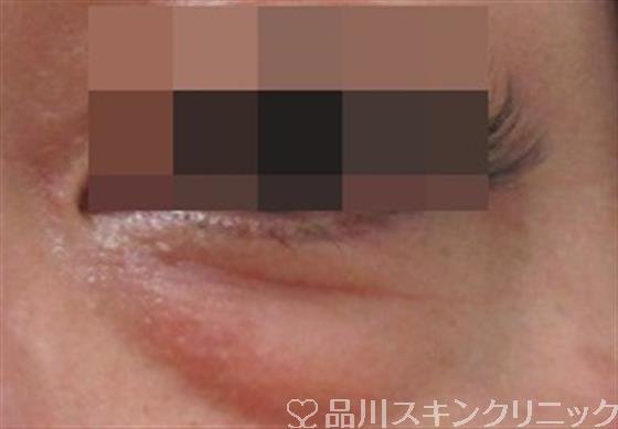 症例NO.30424のBEFORE写真