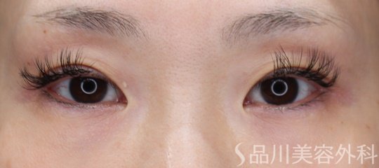 症例NO.69086のBEFORE写真