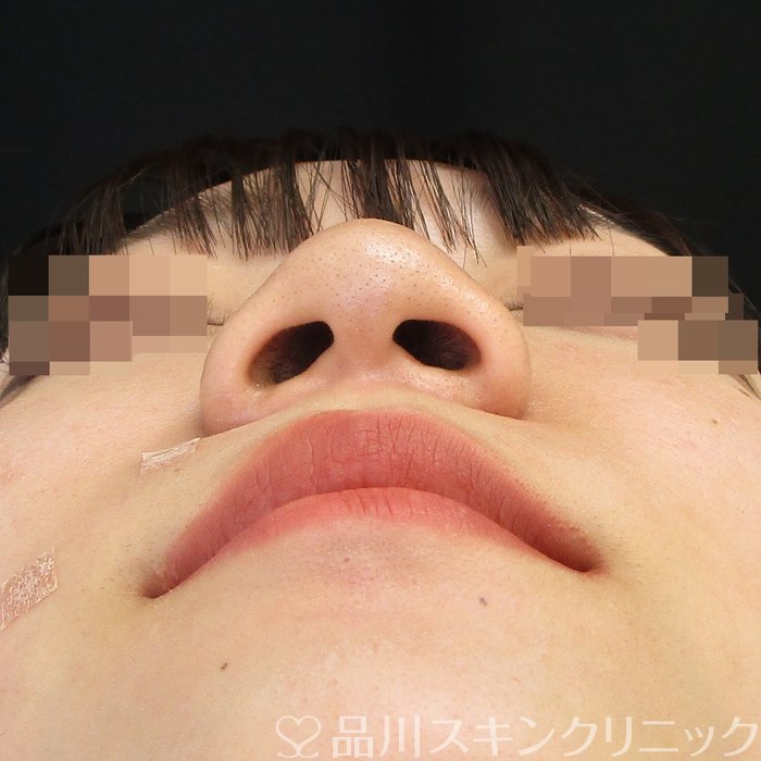 症例NO.62819のBEFORE写真