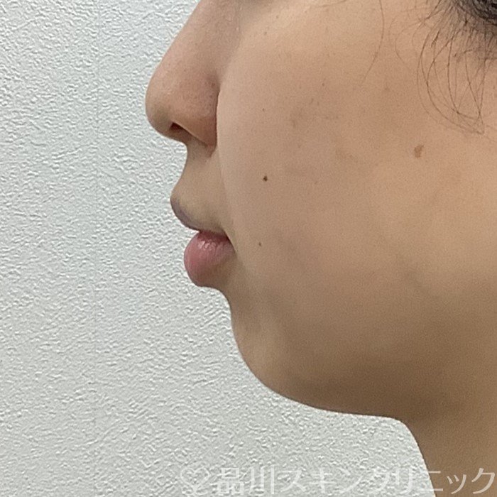 症例NO.66173のBEFORE写真