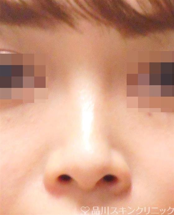 症例NO.44395のBEFORE写真