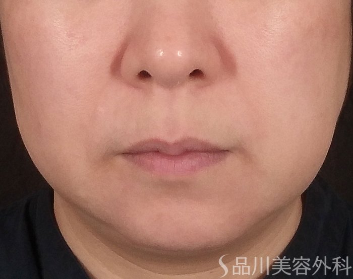 症例NO.68961のBEFORE写真