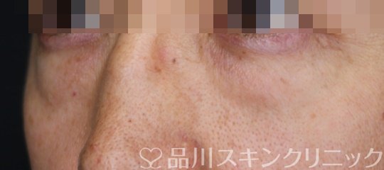 症例NO.64186のBEFORE写真