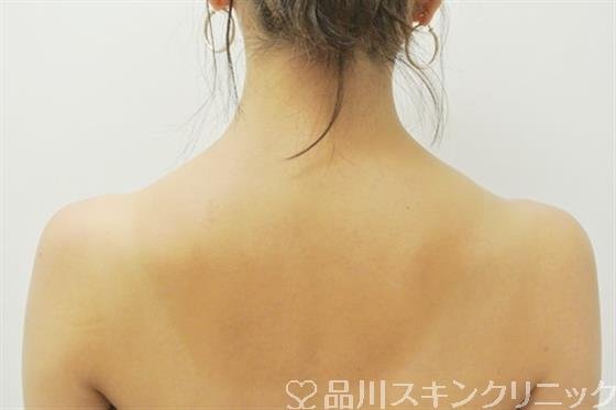 症例NO.30987のBEFORE写真