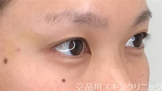 症例NO.55440のBEFORE写真