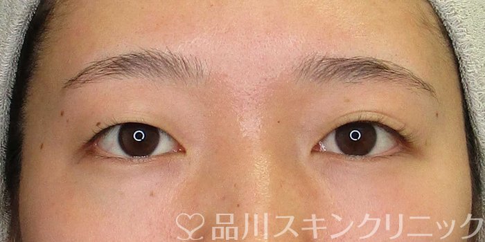 症例NO.67145のBEFORE写真