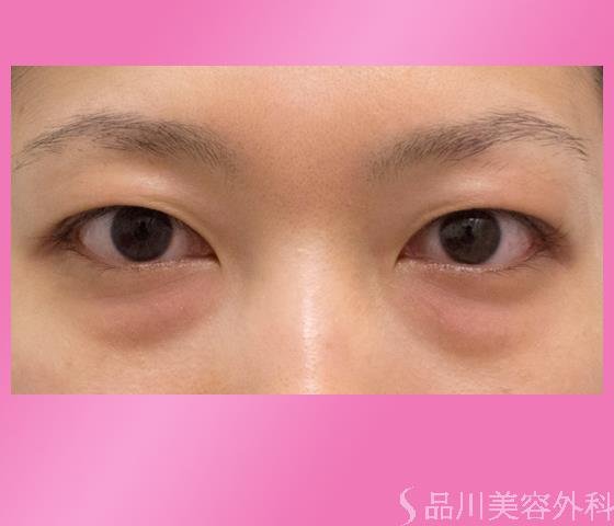 症例NO.23001のBEFORE写真