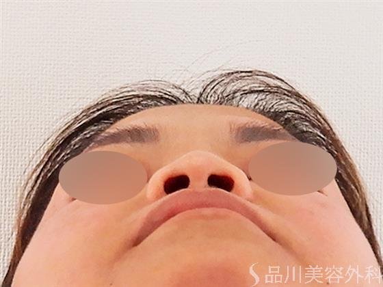 症例NO.59306のBEFORE写真