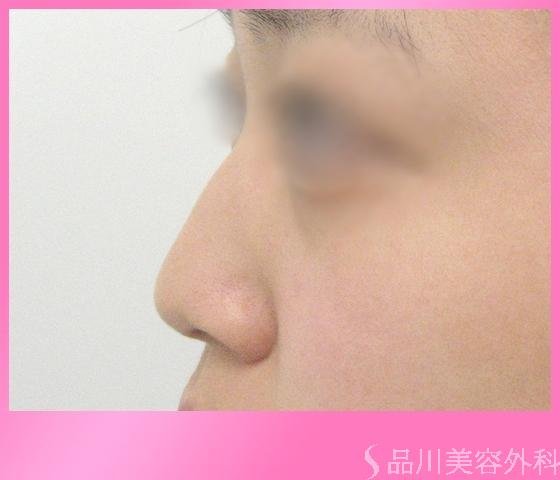 症例NO.1753のBEFORE写真