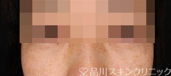 症例NO.50896のAFTER写真