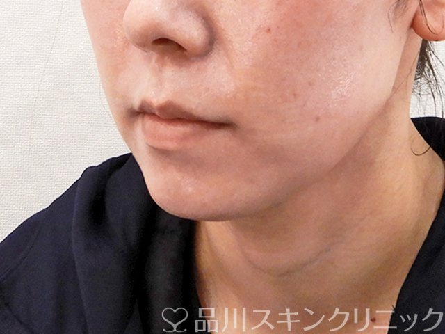 症例NO.62355のBEFORE写真