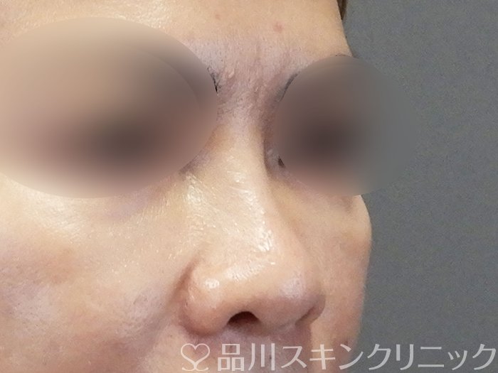 症例NO.67177のBEFORE写真