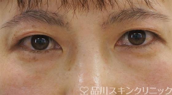 症例NO.51341のBEFORE写真