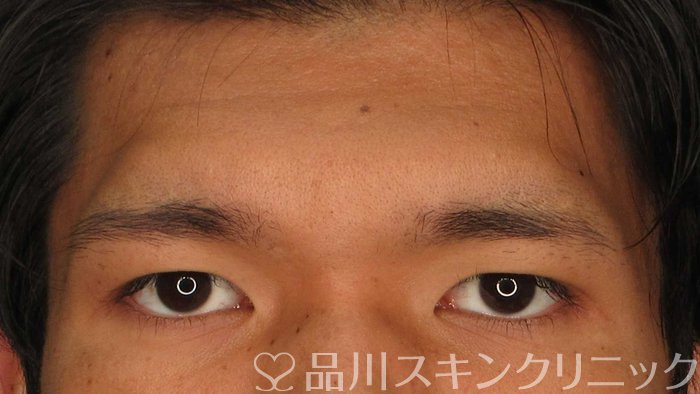 症例NO.66177のBEFORE写真