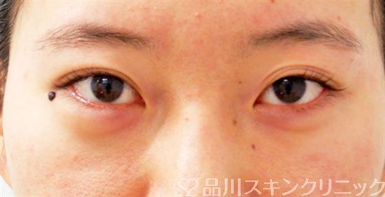 症例NO.53499のBEFORE写真