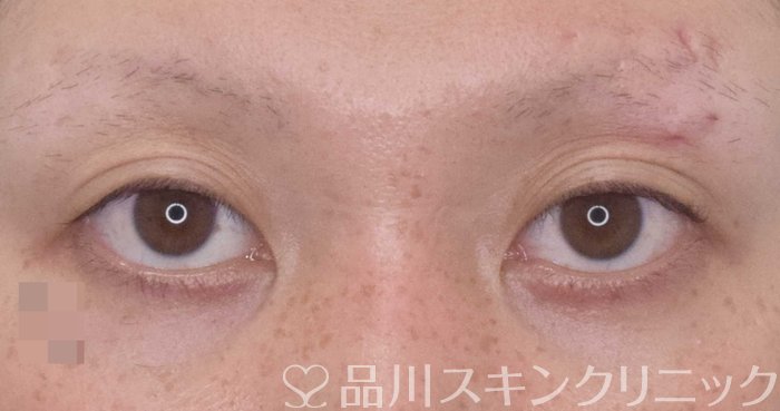 症例NO.66088のBEFORE写真