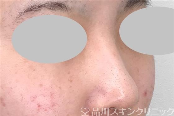 症例NO.55238のBEFORE写真