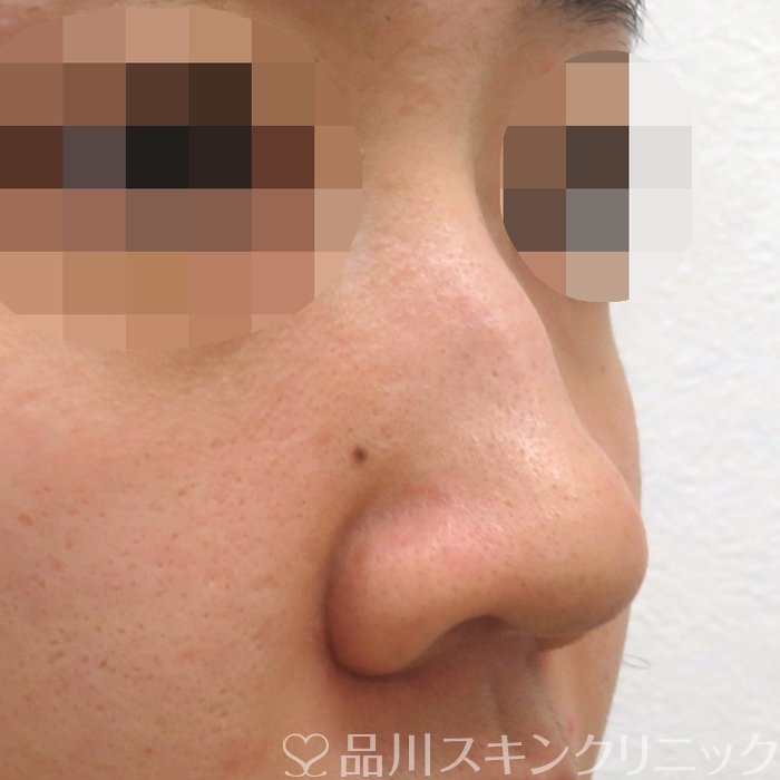 症例NO.66957のBEFORE写真